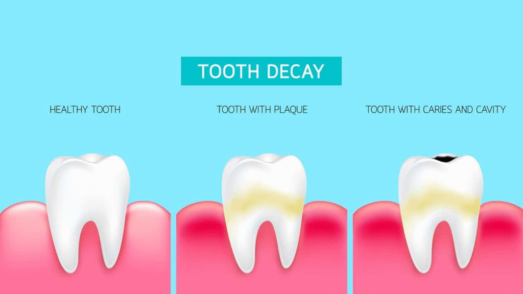 Top 5 Signs You May Have a Cavity