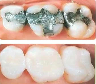 Can You Eat After Filling Teeth?