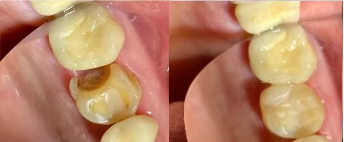 How Long Does It Take to Fill a Cavity? Full Guide